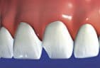Crowns are prescribed for damaged, decayed, or broken teeth.