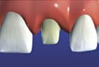 The tooth is prepared for a crown by reshaping the surface structure.