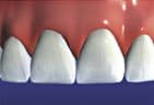 Crowns restore natural beauty and health of teeth and can be used to change the size, shape and shade of teeth.
