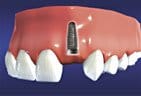 An implant post is surgically placed into the area where the tooth is missing. In a few months bone will fuse to the implant.