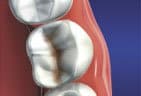 Decayed teeth may require an inlay to restore strength and health to the natural tooth structure.