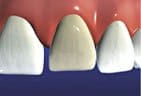 Veneers are prescribed for damaged, discolored, or broken teeth.