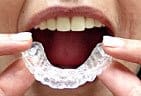 The trays fit tightly over your teeth and are worn for the prescribed time.